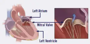 Diagram of the heart's mitral valve from www.cavalierhealth.org